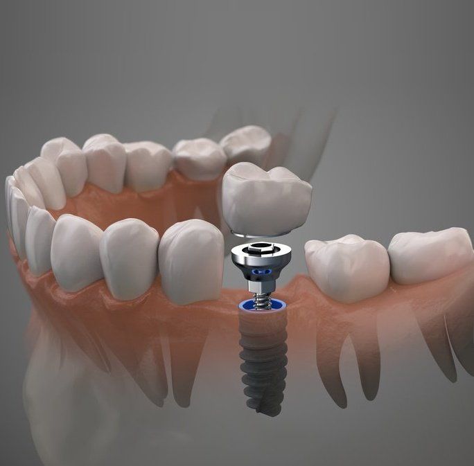 Dental implant procedure